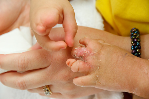 Amelie's Cast comes off