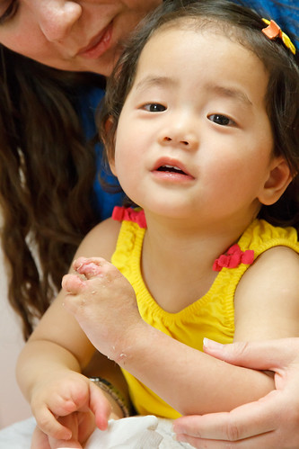 Amelie's Cast comes off